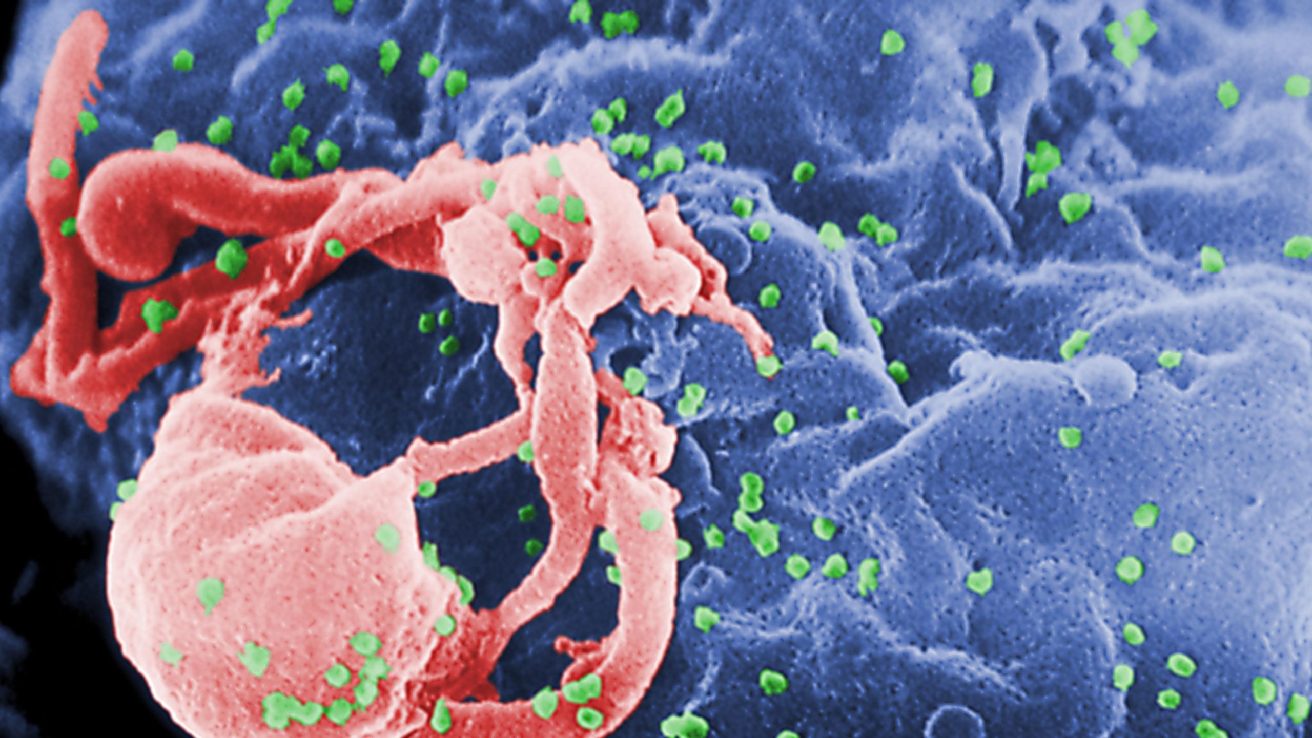 A scanning electron micrograph (SEM) of HIV-1 virions as green round bumps (Image: Smith Collection/Gado,   (Getty Images))