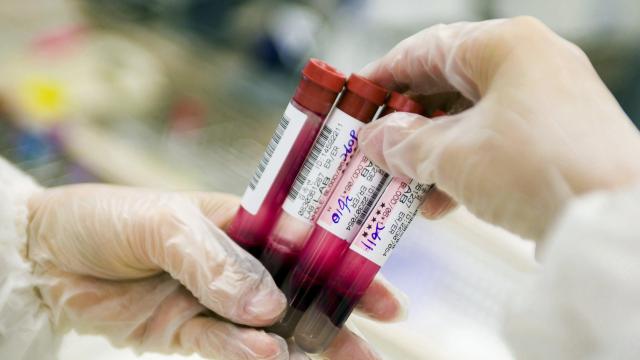 Scientists Say They have Created a Blood Test for Detecting Early Lung Cancer