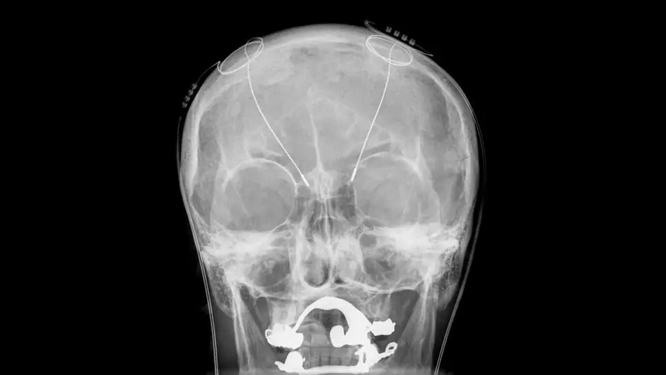 An example of what a deep brain stimulation device looks like under X-ray imaging. (Photo: Hellerhoff/Wikimedia Commons)