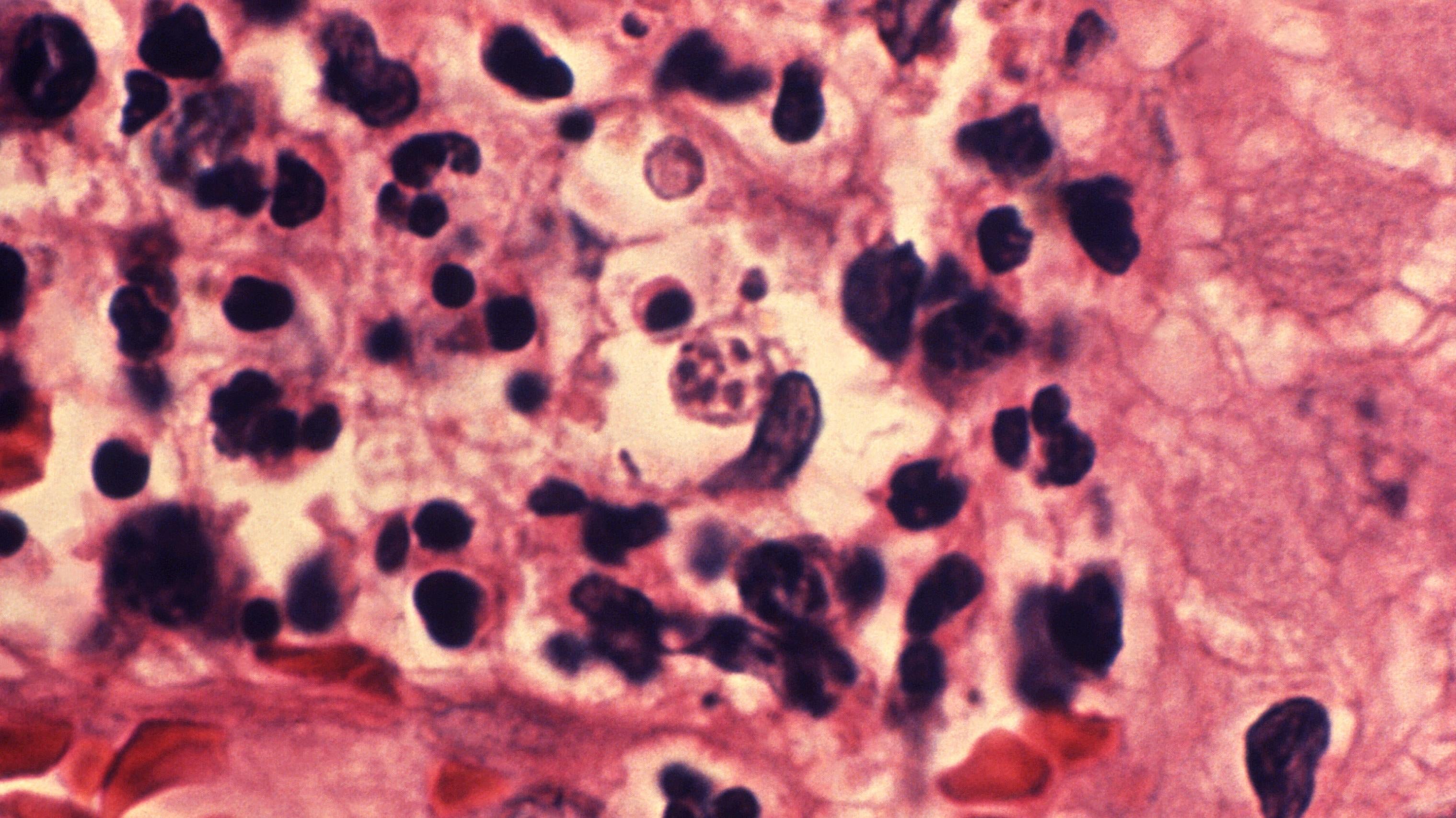 The bacteria that causes donovanosis are difficult to culture, but the infection leaves behind dark-coloured objects called donovan bodies, seen above, in the lesions it causes. (Image: CDC/ Dr. Cornelio Arevalo, Venezuela)