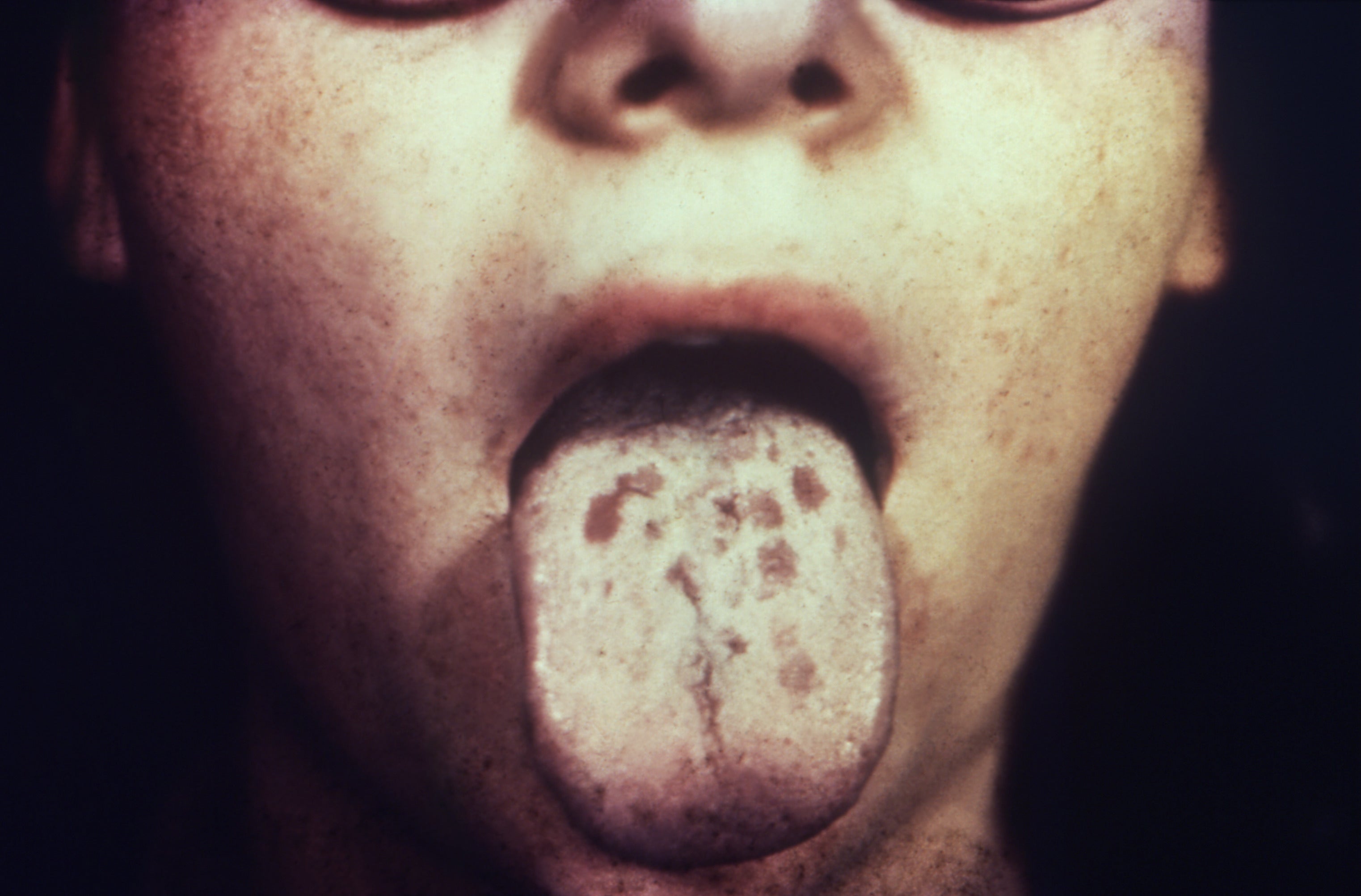 A photograph of someone with mucous patches on their tongue caused by secondary syphilis. (Photo: CDC/Dr. Henderson)