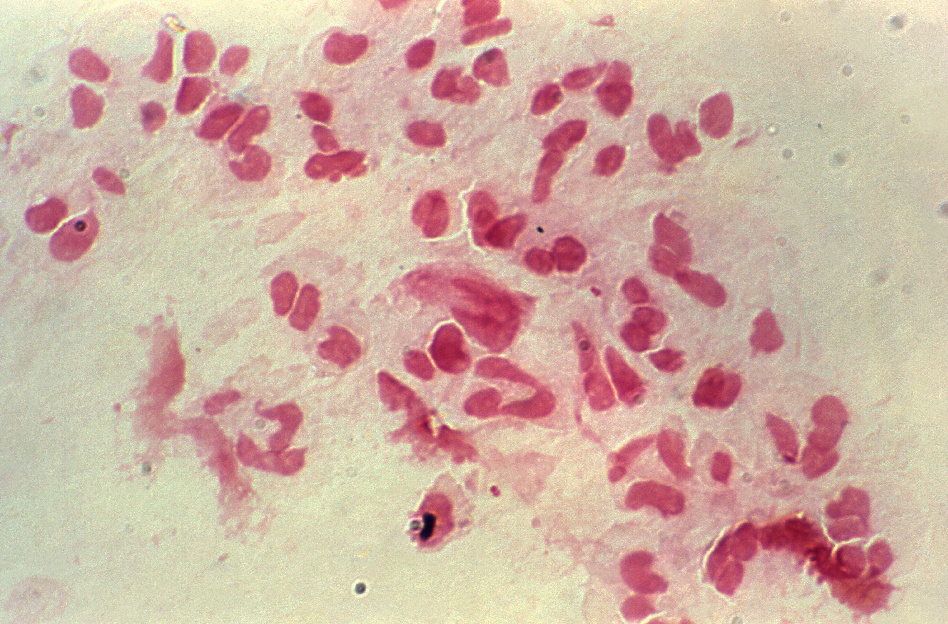 A sample of genital discharge seem under a microscope from someone with gonorrhea. (Image: CDC/Joe Miller)