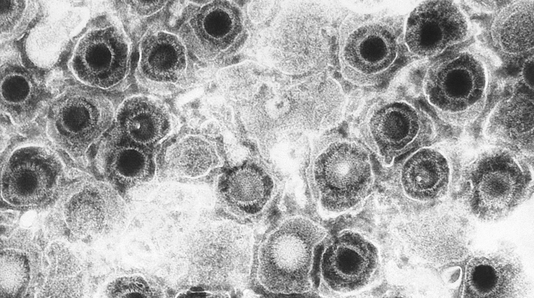 A negative-stained transmission electron microscopic (TEM) image of herpes simplex viruses. (Photo: CDC/Dr. Fred Murphy)