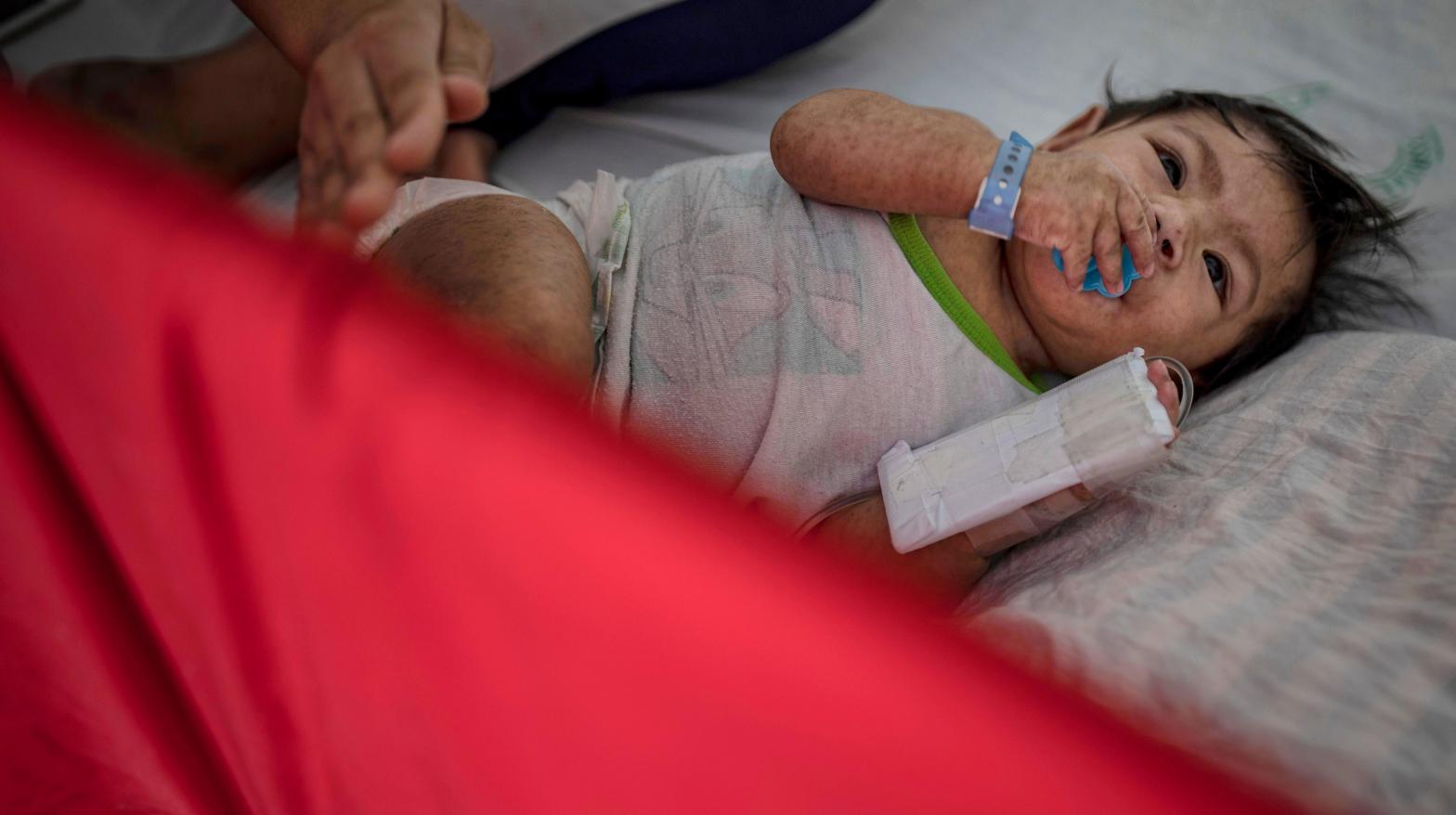 A child suffering from measles is treated at a  hospital on May 4, 2019 in Manila, Philippines.  (Photo: Ezra Acayan, Getty Images)