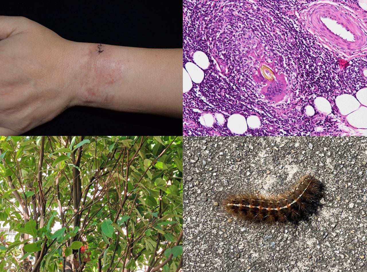 Upper left, the affected area of the man's wrist after biopsy; bottom left: the wax apple tree in his yard; top right: an image of the caterpillar setae under a microscope; bottom right: a spongy moth caterpillar found in the man's yard. (Image: Wen Chen, et al/BMJ Case Reports)