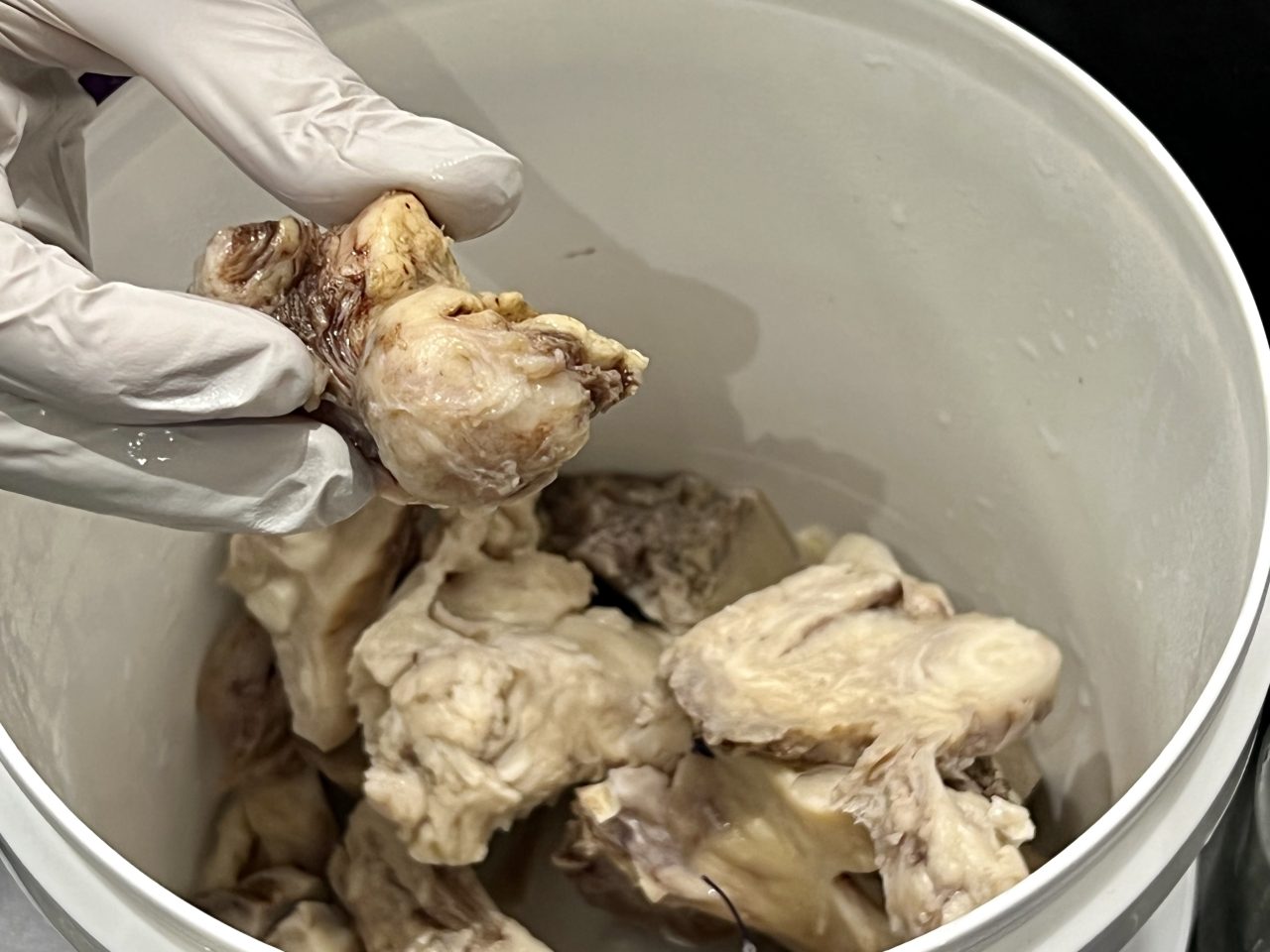 Preserving a human organ: The tumour from the jar held over the bucket of uterus post hysterectomy.