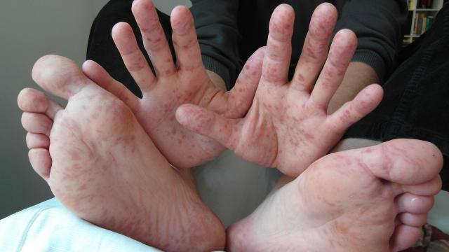 Don’t Mistake These Skin Conditions for Monkeypox