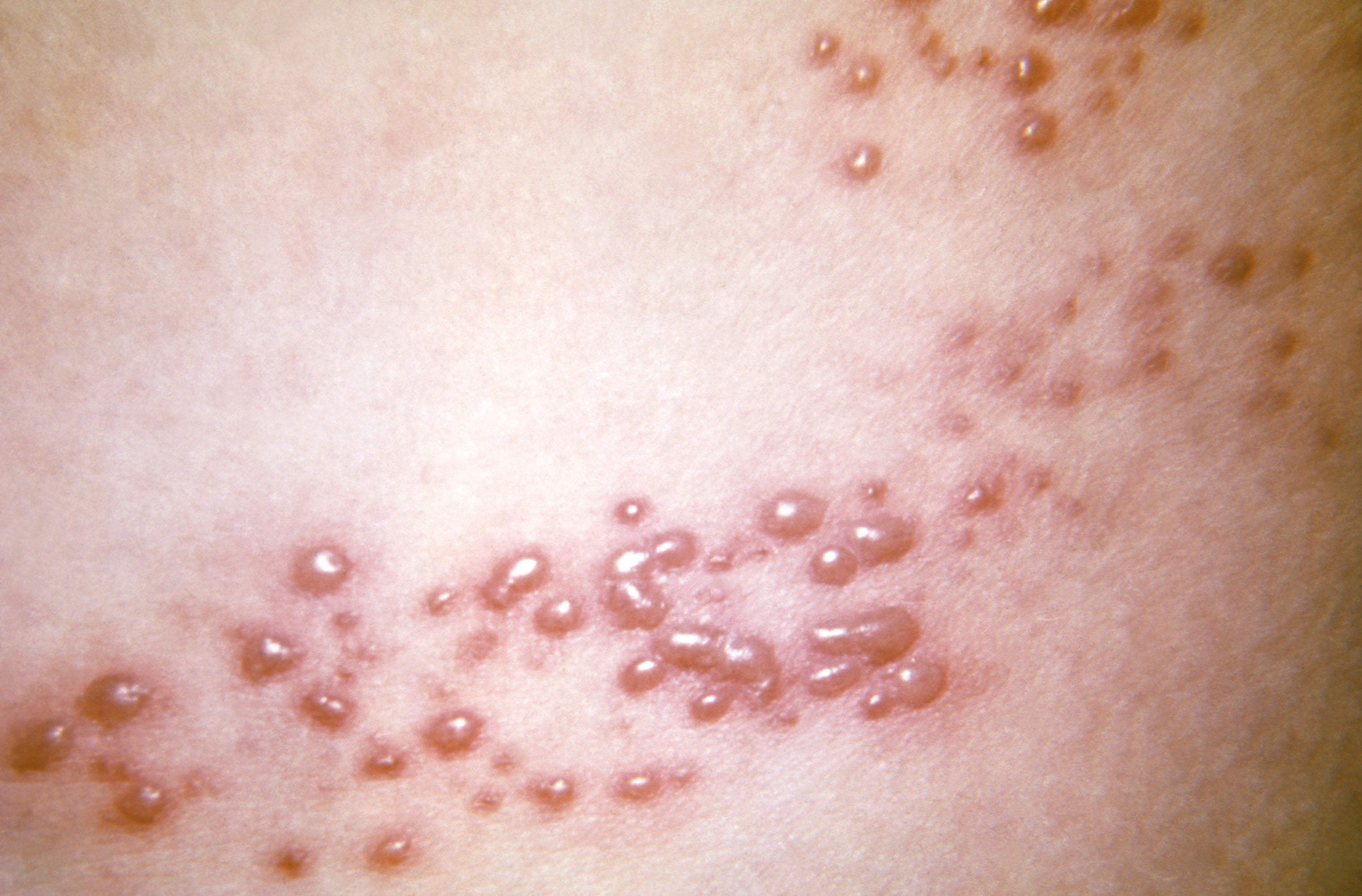 A close-up look at a shingle rash taken in 1966. (Photo: CDC/ K.L. Herrmann)