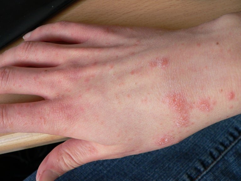 A person's right hand, wrist, and arm six days into their symptoms of scabies. (Photo: Cixia/Wikimedia Commons)