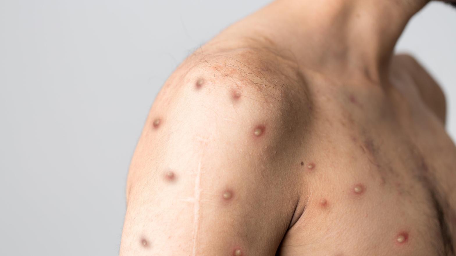 An example of monkeypox rashes.  (Image: Shutterstock, Shutterstock)