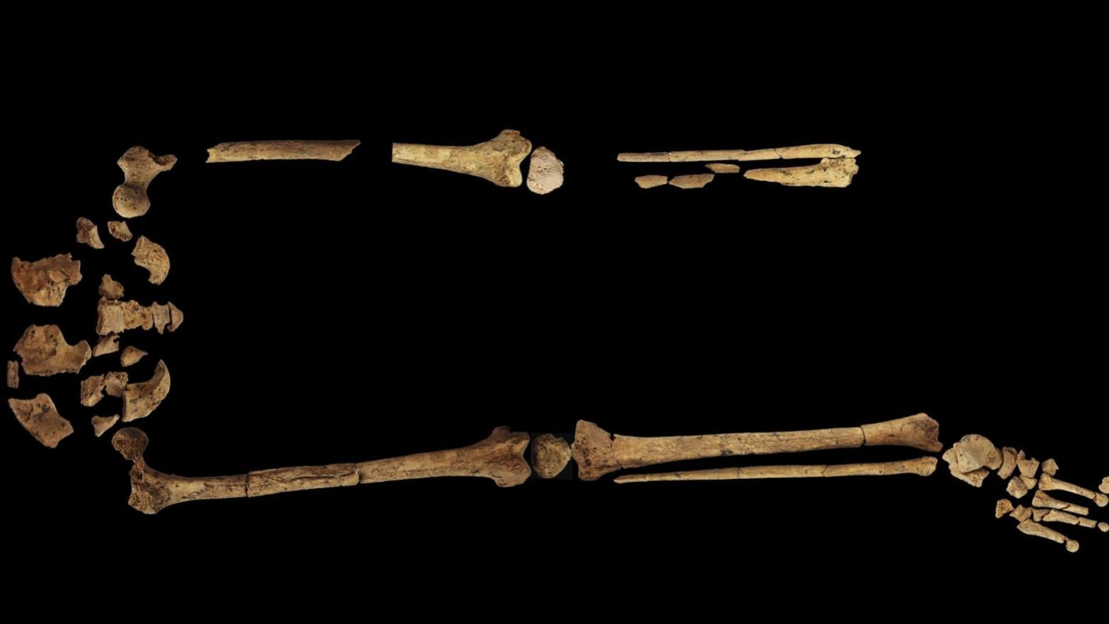 The  skeletal remains of a man's right and left leg, showing that the left foot was completely amputated years before his death.  (Image: Maloney, et al/Nature)