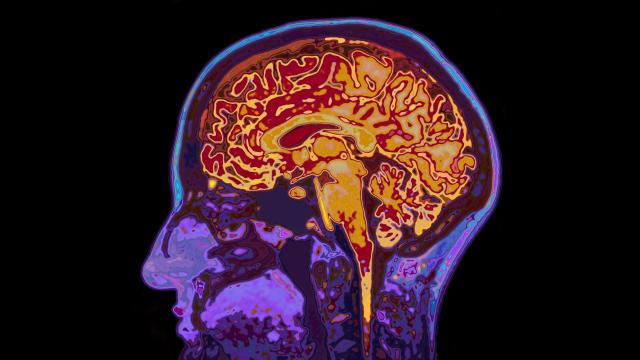 Experimental Alzheimer’s Drug Succeeds in Large Trial, but Questions Remain