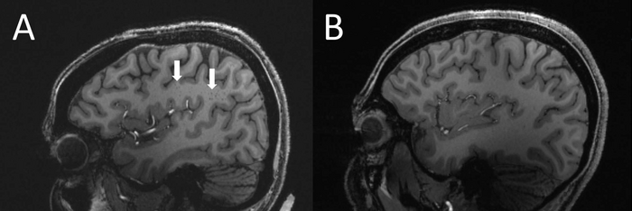 The arrows on the left point to enlarged perivascular spaces seen in the centrum semiovale of someone with chronic migraines. The brain scan on the right with no enlarged spaces is taken from a control with no migraines. (Image: RSNA and Wilson Xu)