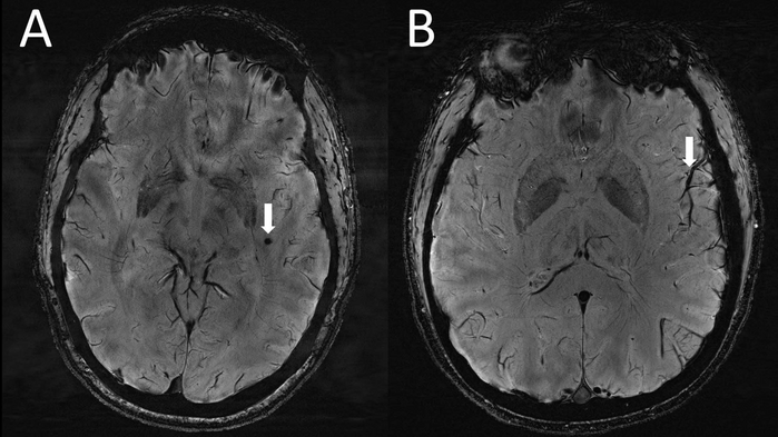 On the left, an arrow points to cerebral microbleeds captured in the left temporal lobe in a migraine case with aura. On the right, the arrow points to another possible abnormality on the same side of the microbleeds.  (Image: RSNA and Wilson Xu)