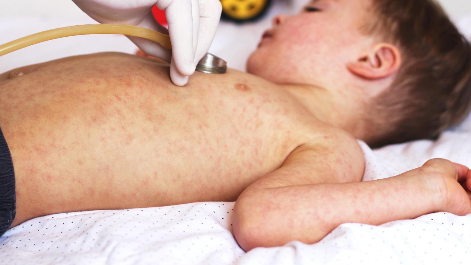 A child with a measles rash. (Photo: Shutterstock, Shutterstock)