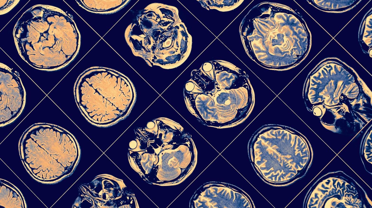 MRI brain images. (Image: Shutterstock, Shutterstock)