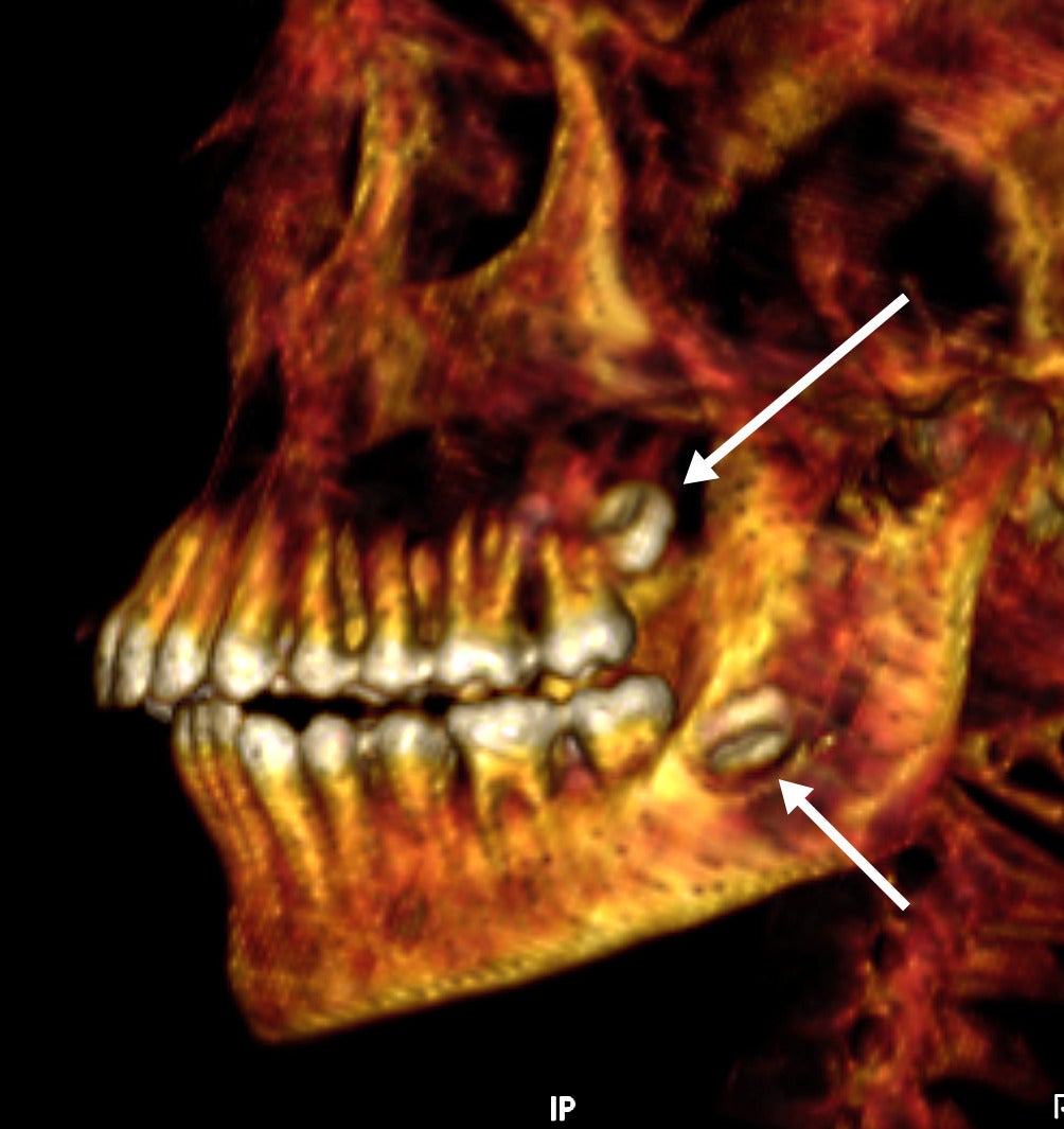 The mummy's teeth. (Image: SN Saleem, SA Seddik, M el-Halwagy)