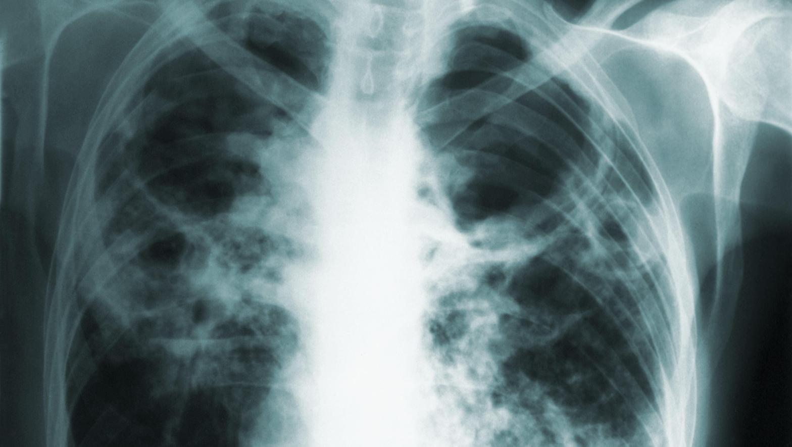 A chest X-ray of a tuberculosis patient.  (Image: CDC/ Richard Larkin)