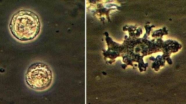 Man With Brain-Eating Amoeba Infection Saved by Old UTI Drug