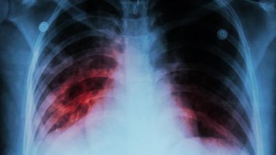 Washington Woman to Be Arrested After Refusing Tuberculosis Treatment