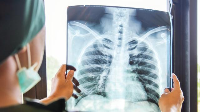 Tuberculosis-Infected Woman Still Going Out in Public Despite Arrest Warrant