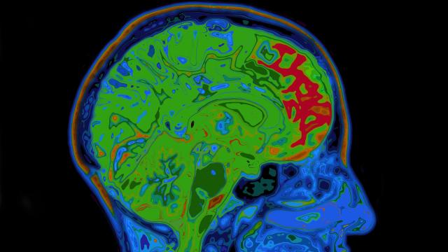 New Trial Data Is Strongest Yet for Any Experimental Alzheimer’s Drug