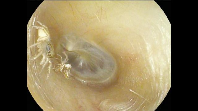 Woman Hearing Strange Sounds Finds Out She Had a Spider in Her Ear