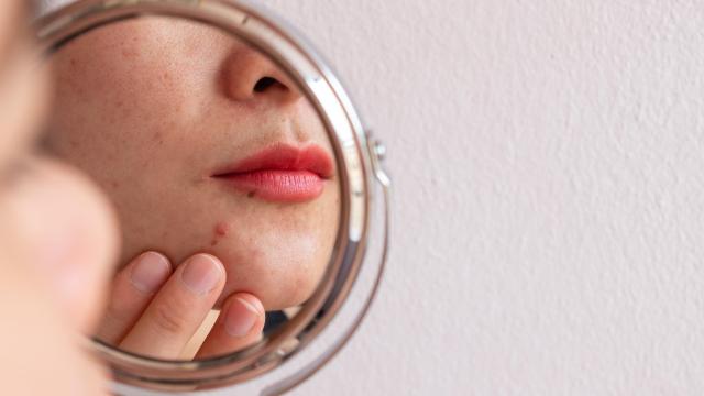 People With Acne Pay a Steep Social Price, Study Finds