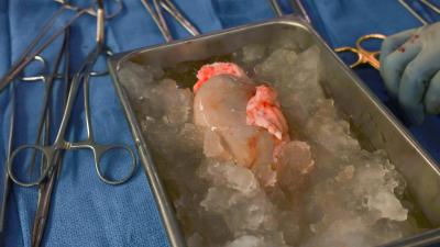 62-Year-Old Man Doing Great After Leaving Hospital With Pig Kidney