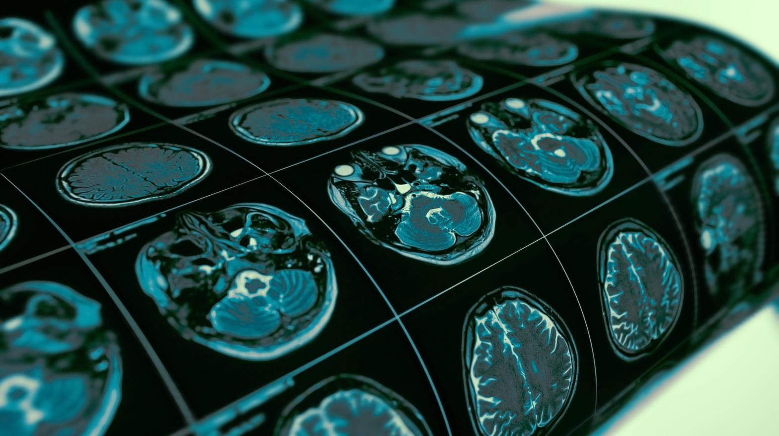 You’re Practically Guaranteed to Get Alzheimer’s If You Have This Genetic Variant